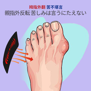 Iwai Jackson Pharmazeut ische Salbe Kinder fuß Daumen Ectropion Corrector Chinesisches Pflaster für Gelenk knochen - Product Image 4