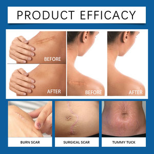 Nuevo Gel para <span class=keywords><strong>Eliminar</strong></span> Cicatrices a Bajo <span class=keywords><strong>Precio</strong></span> y de Alta Demanda, Adecuado para Situaciones como Marcas y <span class=keywords><strong>Estrías</strong></span> Durante el Embarazo. - Product Image 2