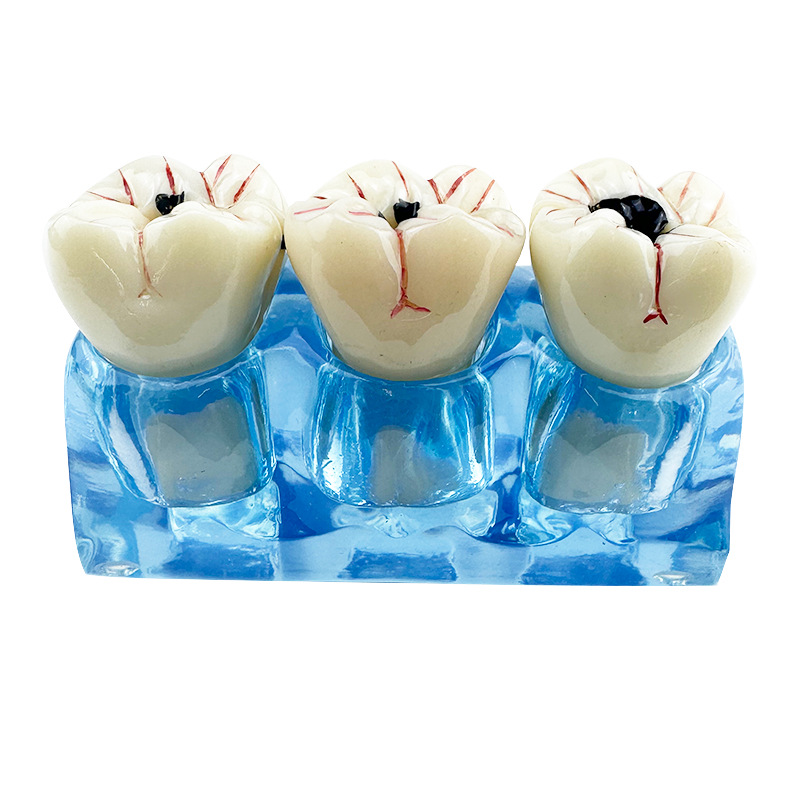 Dental Decayed Teeth Model