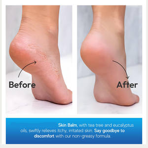 มิราเคิล สกิน บาล์ม - บรรเทาอาการผิวแห้ง คัน ลอกเป็นขุย บริเวณเท้า ลำตัว นิ้วเท้า ด้วยทีทรีออยล์และยูคาลิปตัส ช่วยบรรเทาอาการปวดอย่างรวดเร็วและเพิ่มความชุ่มชื้น - Product Image 5