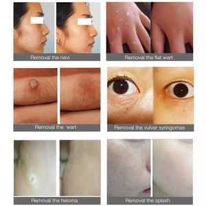 Dispositivo di bellezza portatile per la rimozione di talpa personale per uso domestico viso sbiancamento e rimozione macchie scure ABS palmare - Product Image 6