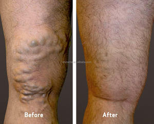 OEM ODM verimli varisli örümcek damarları doğal tedavi güçlendirilmesi kılcal damarlar dolaşımını iyileştirmek yatıştırıcı bacak kremi - Product Image 4