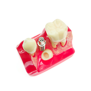 Modèle dentaire, modèle pédagogique buccal, modèle d'implant dentaire détachable, modèle de communication médecin-patient, modèle de soins dentaires - Product Image 4