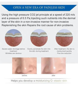 Yeni <span class=keywords><strong>CO2</strong></span> tabancası düşük sıcaklık yüksek basınç cilt gençleştirme <span class=keywords><strong>CO2</strong></span> dondurulmuş hidrasyon kırışıklık kaldırma dondurulmuş cilt <span class=keywords><strong>Co2</strong></span> gaz tedavisi - Product Image 3