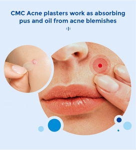 Parches Adhesivos para el Acné, Ultrafinos, Hidrocoloides, con Dibujos Animados Coloridos, Fórmula Segura, Producto de Belleza y Cuidado Personal - Product Image 3
