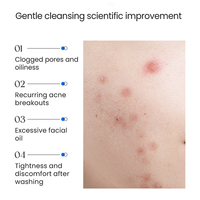 Limpiador Facial Espumoso con 5% de Peróxido de Benzoilo y Ácido Salicílico para el Acné, Control Suave de la Grasa, Limpieza Profunda de Poros para Piel Grasa y Propensa al Acné
