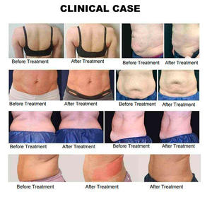 Nouvelle machine amincissante 2 en 1 Trusculpt ID, Cutera Trusculpt Flex 2 en 1 pour le remodelage corporel, pour salon de beauté, ABS monopolaire Trusculpt - Product Image 4