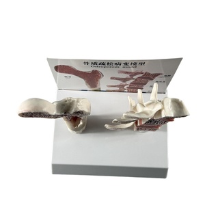 Modèle de pathologie de l'ostéoporose Modèle d'ostéoporose de vertèbre humaine Ensemble de modèles osseux ostéoporotiques - Product Image 2