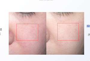 Gel de 1 ml con Ácido Hialurónico <span class=keywords><strong>Reticulado</strong></span>, Hidratante Multiusos y Antiarrugas, Ingrediente Estrella Antienvejecimiento <span class=keywords><strong>para</strong></span> Rostro, <span class=keywords><strong>Labios</strong></span>, Ojos y Nariz - Product Image 4