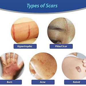 Crema Anti-<span class=keywords><strong>Cicatrices</strong></span> para <span class=keywords><strong>Cicatrices</strong></span> Antiguas <span class=keywords><strong>en</strong></span> la Pierna, Gel de Silicona Médica para el Tratamiento de <span class=keywords><strong>Cicatrices</strong></span> - Product Image 5