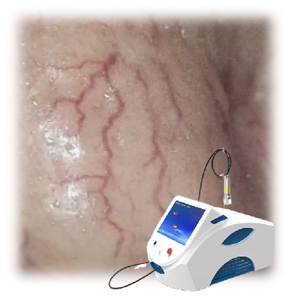 Venta superior portátil 980nm Máquina vascular de eliminación de venas varicosas Láser de Diodo endovenoso Máquina de eliminación vascular - Product Image 2