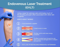 Machine de liposuccion de traitement endoveineux EVLT à diode laser 1470nm pour l'élimination des varices de la jambe faciale Soins personnels de beauté