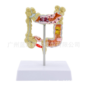 Modèle humain de petite maladie du côlon ; modèle de côlon en proctologie et gastroentérologie ; côlon en gastroentérologie ; intestin. - Product Image 2
