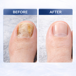 Lápiz para Uñas con <span class=keywords><strong>Aceite</strong></span> <span class=keywords><strong>de</strong></span> Árbol <span class=keywords><strong>de</strong></span> Té para Uñas Propensas a Hongos, Cuidado Hidratante <span class=keywords><strong>de</strong></span> Cutículas con <span class=keywords><strong>Propiedades</strong></span> Antifúngicas, Precisión - Product Image 4