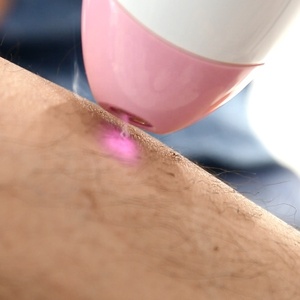 Máquina de Depilación Láser de Diodo Portátil Vilase Personalizable con 999,999 Pulsos, Longitud de Onda de 810nm y Tamaño de Punto de 5x5mm para Mujeres - Product Image 4