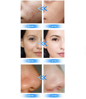 Appareil de pulvérisation d'oxygène aquatique Jet Peel, instrument facial non invasif pour l'élimination des peaux mortes et la revitalisation cutanée, équipement de salon