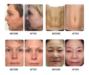 Máquina de Belleza para Rejuvenecimiento Facial con Nanoneedles Mr18-2s para Uso en Salón - Product Image 6