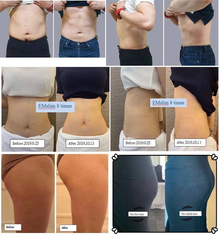Rf 7 Tesla Ems Slimming Machine For Burn Fat