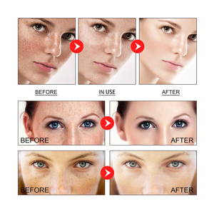 30pcs mặt tối tại chỗ Corrector làm trắng cháy nắng bướm Rạng rỡ mang thai điểm mụn đánh dấu tàn nhang loại bỏ chất lỏng - Product Image 6