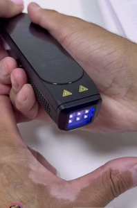 Sistema de Terapia de Luz LED para el Tratamiento de Enfermedades de la Piel, Dispositivo de Luz Ultravioleta de 308nm para Vitiligo, Psoriasis y <span class=keywords><strong>Eccema</strong></span> - Product Image 2
