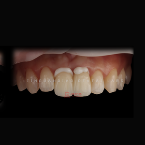 Fournitures pour prothèses dentaires Produits dentaires Placage en porcelaine Restauration de prothèses fixes <span class=keywords><strong>Sourire</strong></span> <span class=keywords><strong>parfait</strong></span> - Product Image 1