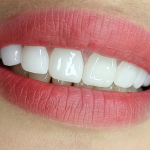 อิโฮก้า ทีธ คัฟเวอร์ วีเนียร์ส สีขาว สำหรับใช้ในบ้าน ตกแต่งฟัน - Product Image 1