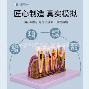Modelo de patología dental completo 6x, un modelo didáctico que demuestra la anatomía de dientes humanos con caries y raíces afectadas. - Product Image 2
