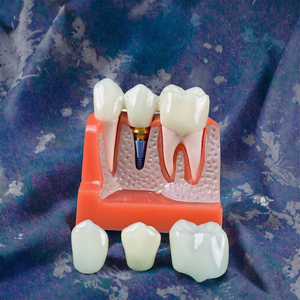 4 volte impianto dentale modello porcellana denti corona rimovibile ponte impiallacciature per la scienza medica studio insegnamento - Product Image 3