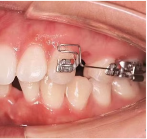 Retentor Ortodôntico Envolvente Hawley para Tratamento de Espaço de Adução - Product Image 1