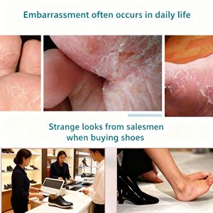 Spray Naturale a Base di Erbe <span class=keywords><strong>per</strong></span> Piede d'Atleta, Spray Antifungino Cinese <span class=keywords><strong>per</strong></span> <span class=keywords><strong>Unghie</strong></span> e Dita dei Piedi - Product Image 6