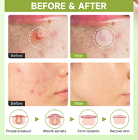 Patchs Coréens Hydrocolloïdes Anti-Acné Traitement Ciblé pour Boutons, Imperfections et Acné Imperméables