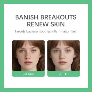 HUAO Crème anti-acné pour réparation rapide et efficace des cicatrices de boutons, élimination des taches, rétrécissement des pores lisse - Product Image 4