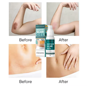 Forte eficaz acne cicatriz remoção creme gel hemorróidas espinha cicatriz acne remoção creme gel