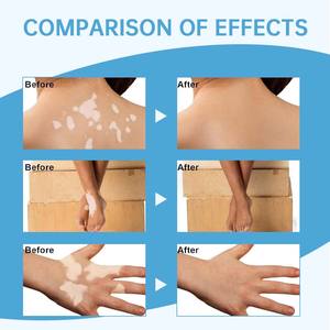 Traitement du <span class=keywords><strong>vitiligo</strong></span> à base de plantes 30ml Vente en gros Soins de la peau Spray dissolvant de taches blanches - Product Image 4