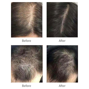 30 giorni frontal <span class=keywords><strong>capelli</strong></span> ricrescere la <span class=keywords><strong>perdita</strong></span> dei <span class=keywords><strong>capelli</strong></span> trattamento e ripristinare la <span class=keywords><strong>perdita</strong></span> dei <span class=keywords><strong>capelli</strong></span> per la femmina/maschio - Product Image 6