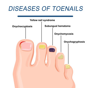 Uñas <span class=keywords><strong>DE</strong></span> LOS PIES <span class=keywords><strong>Hongo</strong></span> Dedo y dedo del pie Dispositivo láser <span class=keywords><strong>de</strong></span> limpieza <span class=keywords><strong>de</strong></span> uñas - Product Image 5