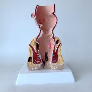 Menselijk Colorectaal Model Rectaal Pathologisch Aambei Model Anale Fistel Anatomisch Model - Product Image 4