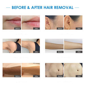 EosICE Super Power 3000W 808nm Diode Laser penghilang rambut tanpa rasa sakit pegangan dapat diubah peralatan kecantikan Pencabut rambut Laser - Product Image 2