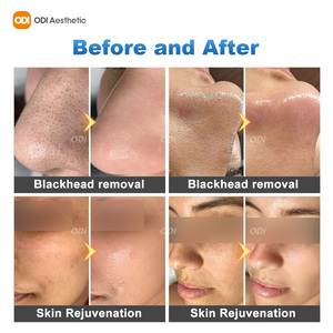 เครื่องไฮโดรเดอร์มาเบรชั่น <span class=keywords><strong>Skinpro</strong></span> สำหรับผู้เชี่ยวชาญด้านความงาม พร้อมระบบดูดสิวเสี้ยน และเครื่องไดมอนด์เดอร์มาเบรชั่น - Product Image 6