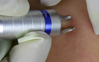 Machine de traitement au laser pour varices, 980nm, élimine les varices, nouveau design, 2020