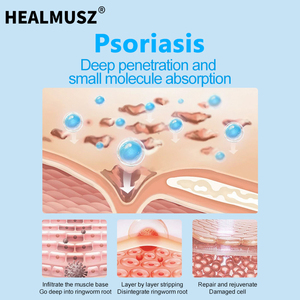 Kem trị bệnh vẩy nến trị ngứa-Phân phối Bán Buôn & tìm nguồn cung ứng từ nhà máy ban đầu (với tác dụng giảm ngứa & sửa chữa) - Product Image 4