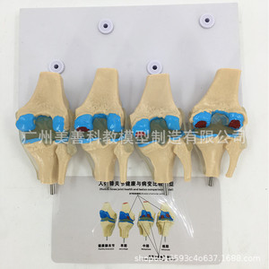 Modelo esquelético patológico de articulación de rodilla en cuatro partes; modelo de articulación de rodilla patológica/con lesiones; articulación degenerativa. - Product Image 1
