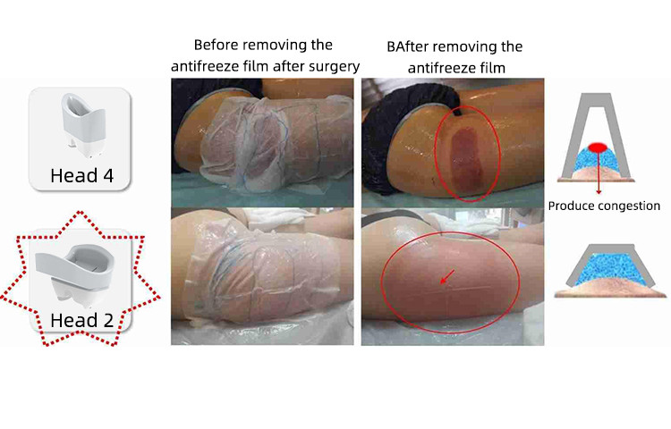 HOT Sales Cryotherapy machine 360 cooling technology Non-invasive fat reduction any treatment area at any angle