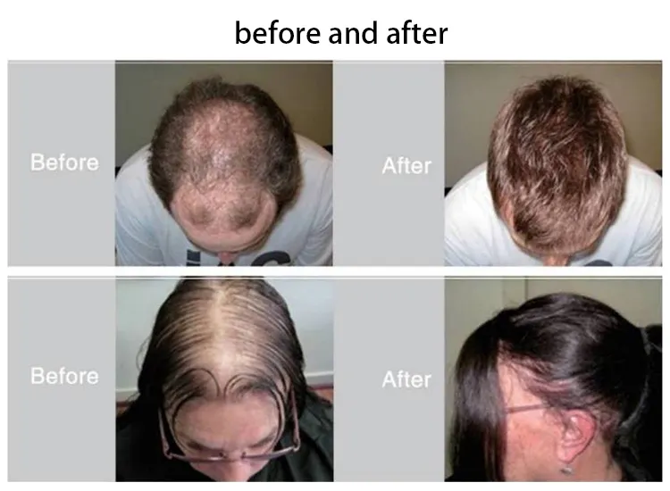 Anti Haarverlies Behandeling Licht Therapie Voor Haargroei Regrow Cap Stimulatie Haargroei Therapie Laser Rood Licht Therapie Led