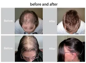 علاج مضاد لتساقط الشعر علاج بالضوء لإعادة نمو الشعر علاج بحثّ للشعر لنمو الشعر بالليزر علاج بالضوء الأحمر بإضاءة ليد