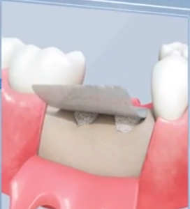 GBR <span class=keywords><strong>Dental</strong></span> membrana Bio impianti dentali Membranel protesi dentarie innesto - Product Image 5