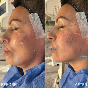 Fibra Endolaser para lipólise Cut Soft Tecido Bodylift Fibra Óptica SMA905 - Product Image 4