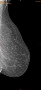 Nuevo estilo Radiolog X Ray Detector de mamografía de panel plano - Product Image 5