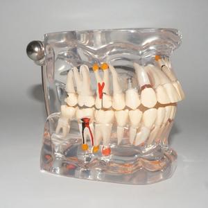 Modelo Dental Transparente <span class=keywords><strong>de</strong></span> Tamaño Real con Dientes Patológicos para Demostración en la Enseñanza Dental - Product Image 2