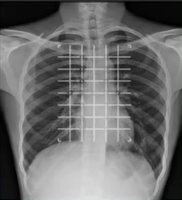 Grille de biopsie radiopâteuse jetable pour CT, grille X, marqueurs d'imagerie radiopâteuse, ruban adhésif, localisateur pour la chirurgie, mesure